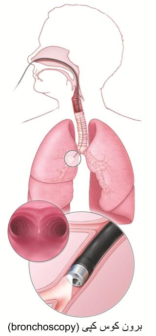 برای استفاده از برون کوس کپ، یک متخصص میله قابل انعطاف و ظریفی را از راه بینی یا دهان به ریه وارد می کند. نور (لامپ) و یک دوربین کوچک به پزشک متخصّص اجازه میدهد که راههای تنفسی و ریه را ببیند کند.